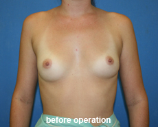 plastic-surgery-breast-augmentation
